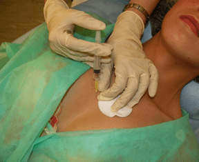 Mezokokteiļa ievadīšana krūšu audos - alternatīva hialuronskābes injekcijām