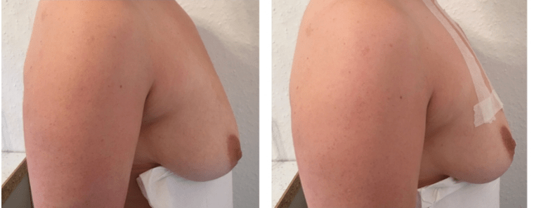 Pirms un pēc pavediena krūšu pacelšana