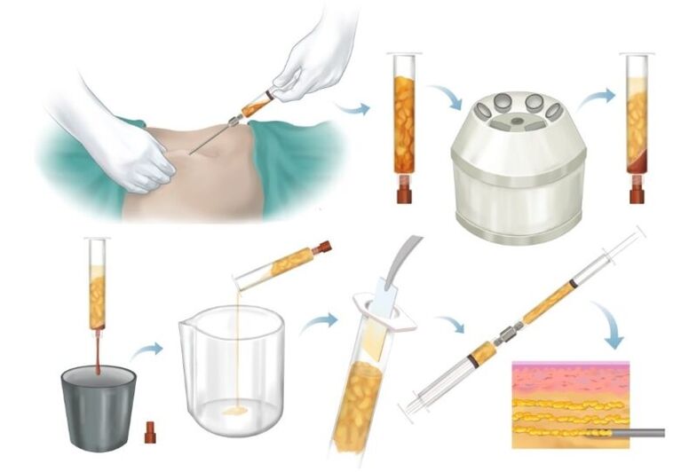 Tauku noņemšana no problēmzonām, apstrāde un ievadīšana krūšu audos