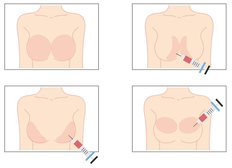 Vietas hialuronskābes injekcijām krūtīs